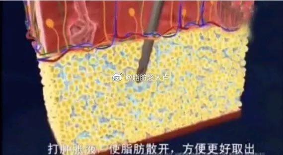 吸脂术后有积液是啥原因?