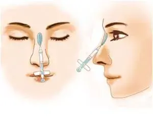 注射隆鼻、线雕隆鼻、假体隆鼻、自体肋骨隆鼻,哪个适合你?