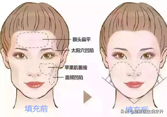 被大家“吹上天”的自体脂肪填充,真的有那么好吗?
