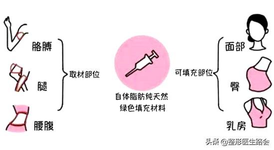 关于自体脂肪填充,那些整形医生不会告诉你的