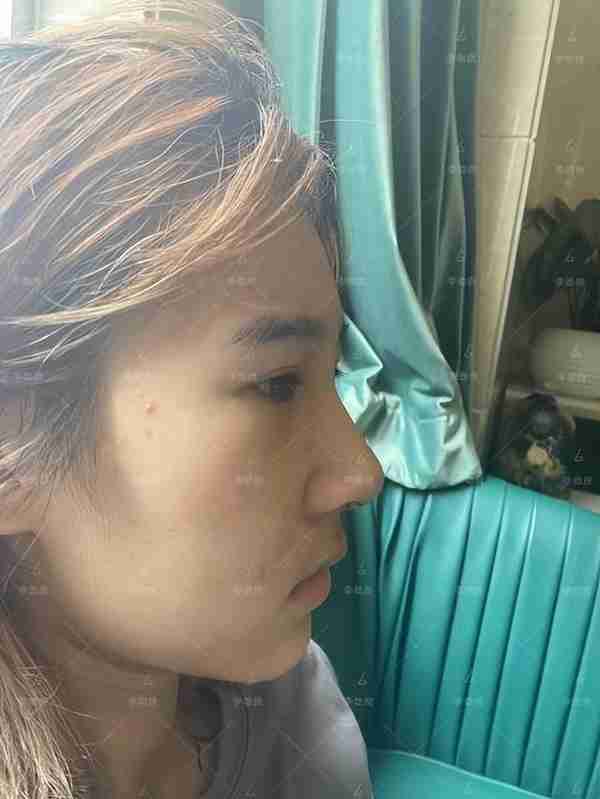 北京20岁女子被叫“大叔”,花6万做鼻子,术后换头,惊艳全家!