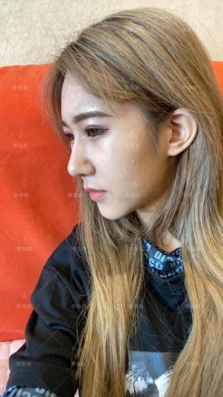 北京20岁女子被叫“大叔”,花6万做鼻子,术后换头,惊艳全家!