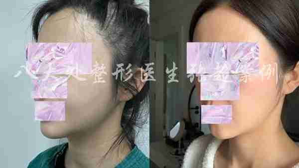 八大处张超面部吸脂反馈合集(五)