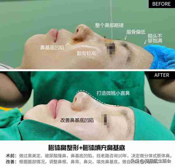 硅胶隆鼻是永久的吗?用它做鼻子有什么危害吗?