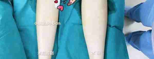 济南艺星大腿/腰腹环吸低￥6800！上臂吸脂￥4800
