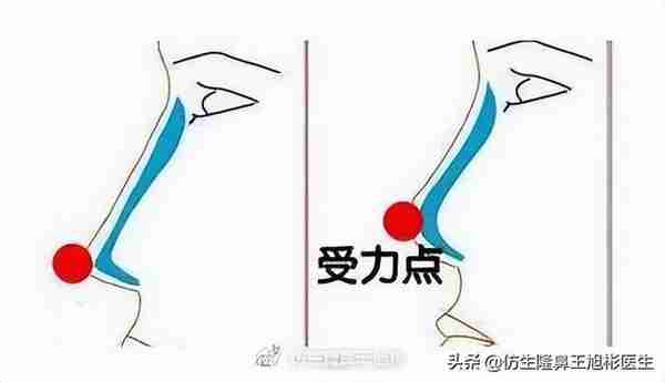 醒醒吧!L型假体隆鼻+耳软骨垫鼻尖,还在骗你是鼻综合