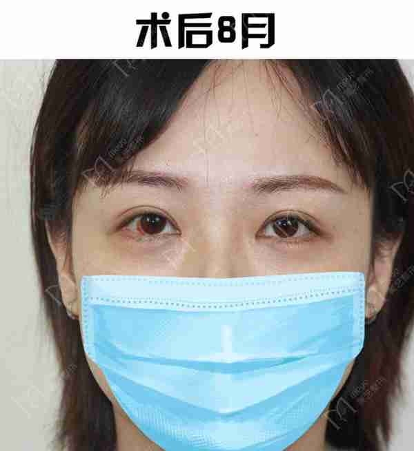双眼皮想要内双变外双,不是说通过双眼皮就可以改善的