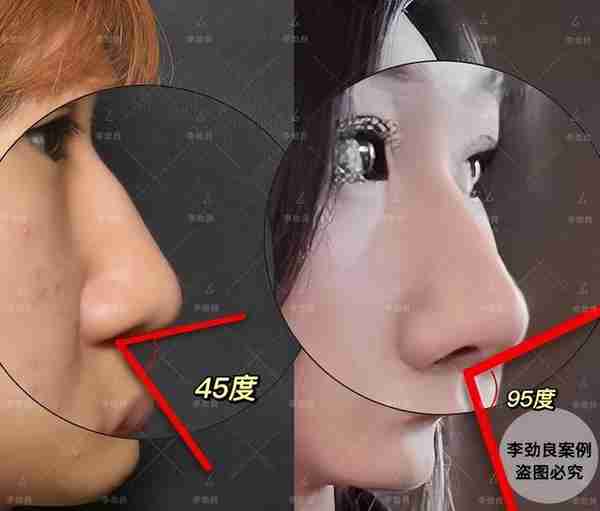 北京20岁女子被叫“大叔”,花6万做鼻子,术后换头,惊艳全家!