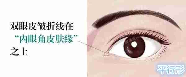双眼皮眼头眼尾为什么会分叉?双眼皮修复时内外高位疤痕的处理?