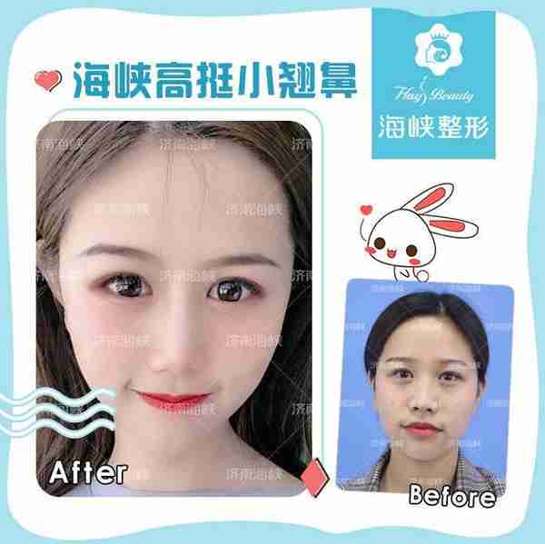 鼻子过短怎么整?