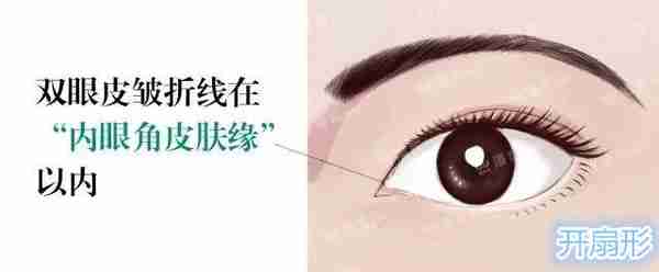 双眼皮眼头眼尾为什么会分叉?双眼皮修复时内外高位疤痕的处理?