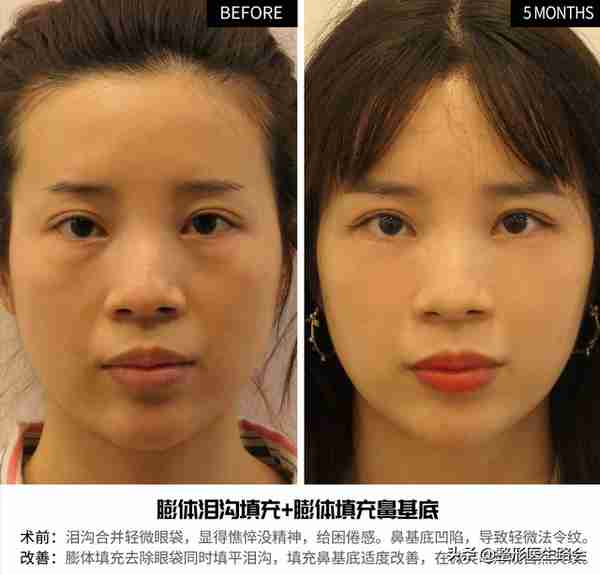 关于玻尿酸隆鼻、填充太阳穴、泪沟,那些医生不会告诉你的