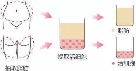 不后悔篇:做“自体脂肪填充”之前,先看看这几个要点