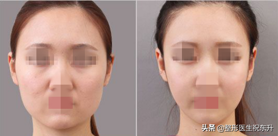 想瘦脸又担心打瘦脸针不安全,有没有其他办法?知道的聊一聊