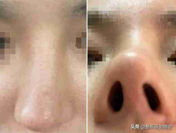 网上大热的肋骨鼻到底怎么样?取肋软骨会对身体有影响吗?