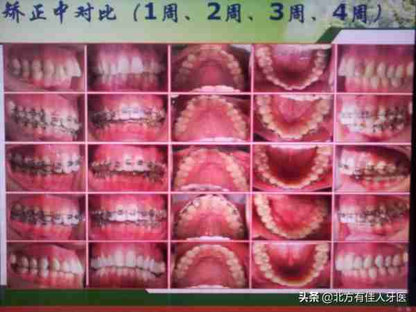 快速矫正有多快?一个月牙齿就整齐