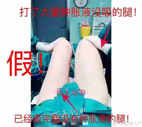 吸脂术后有积液是啥原因?