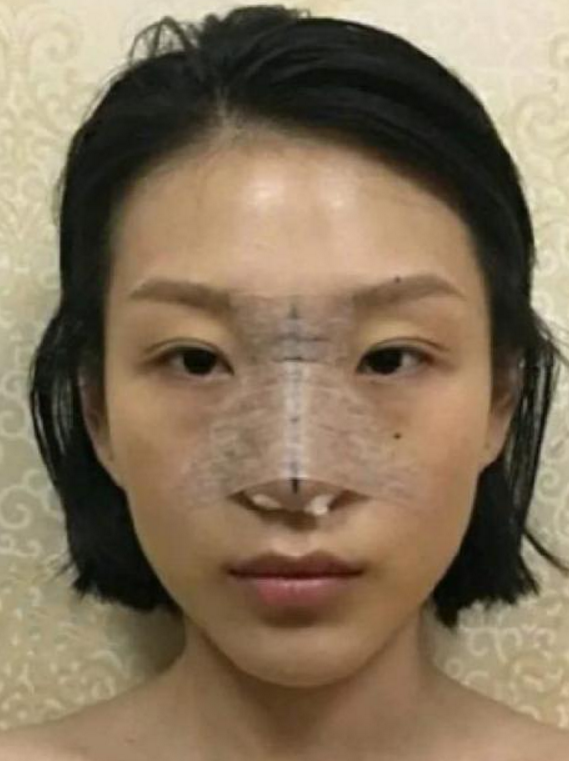 想要做成高级脸,鼻综合:肋软骨隆鼻