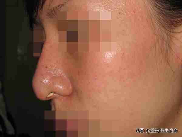 硅胶隆鼻是永久的吗?用它做鼻子有什么危害吗?