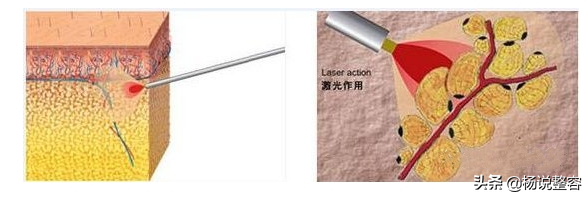 大腿吸脂手术,想要瘦腿的你知道多少?