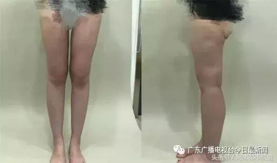 江苏23岁女子花1万5做吸脂术,半年后腿上全是坑!