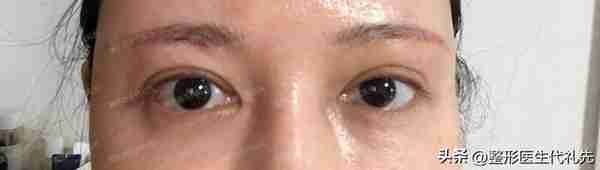 本身眼睛就长得非常好看,只想做个提眉手术恢复原来的双眼皮样子