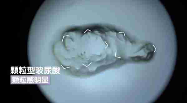 好的玻尿酸拥有哪些特质?种类繁多,玻尿酸该怎么选?