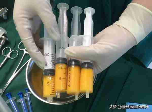 脂肪填充面部 | 别人看出来变美了,不知道哪里变了