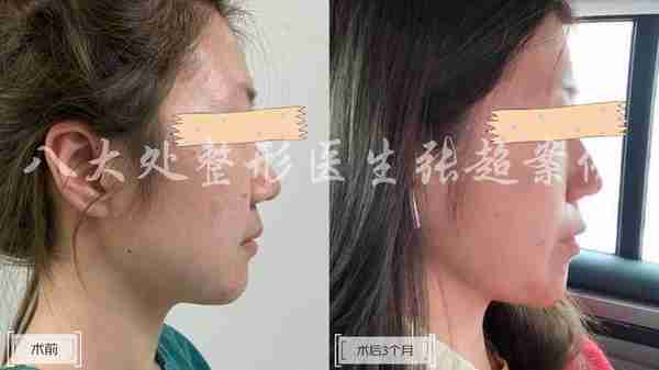 八大处张超面部吸脂反馈合集(五)