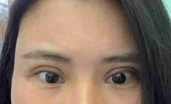 双眼皮手术后不好看,再修复一下不就行了吗?