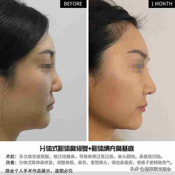 “玻尿酸隆鼻”是大热项目,简单快速,为什么我不建议大家做?