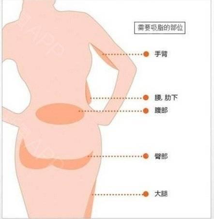 和运动瘦身相比,吸脂塑形的优势竟是这个!选它