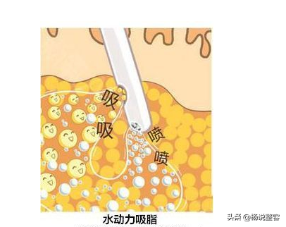 大腿吸脂手术,想要瘦腿的你知道多少?