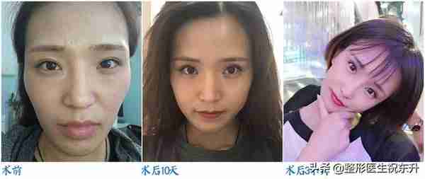 被大家“吹上天”的自体脂肪填充,真的有那么好吗?