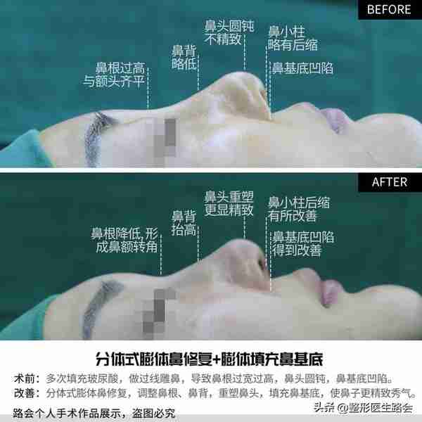 “玻尿酸隆鼻”是大热项目,简单快速,为什么我不建议大家做?
