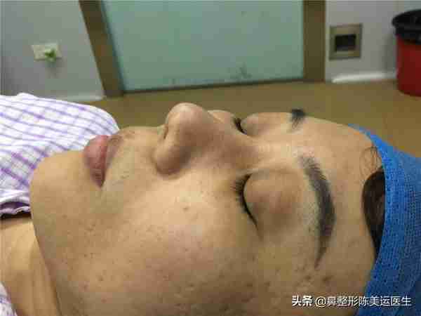 鼻整形术后严重疤痕增生该如何修复?