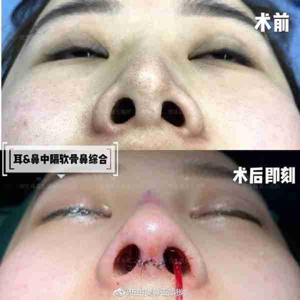 醒醒吧!L型假体隆鼻+耳软骨垫鼻尖,还在骗你是鼻综合