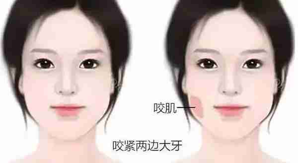 你适合打瘦脸针吗?