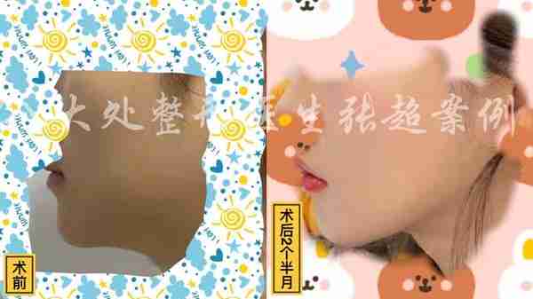 八大处张超面部吸脂反馈合集(五)