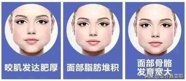 关于瘦脸针,你们想了解的都在这儿了