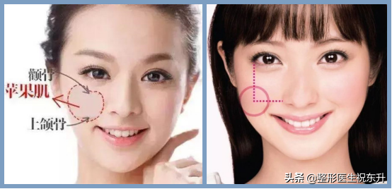 填充苹果肌,选“玻尿酸”好还是“自体脂肪”好?