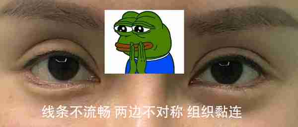 做双眼皮要花多少钱?怎么判断要不要开眼角?有哪些注意事项?