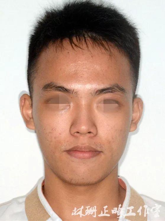 福州牙齿矫正 | 前突龅牙患者害怕骨钉,改用z钩获得很好的内收效果