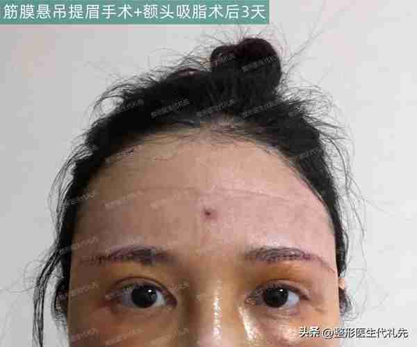本身眼睛就长得非常好看,只想做个提眉手术恢复原来的双眼皮样子