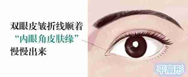 双眼皮眼头眼尾为什么会分叉?双眼皮修复时内外高位疤痕的处理?