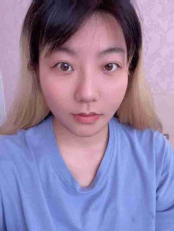 30岁小姐姐做完面部吸脂60天,朋友还以为我悄悄地换了一张脸