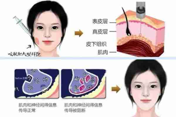 我打瘦脸针“差不多有10年”了,分享真实经验