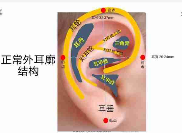 做了耳软骨隆鼻后,我的耳朵会变形吗?