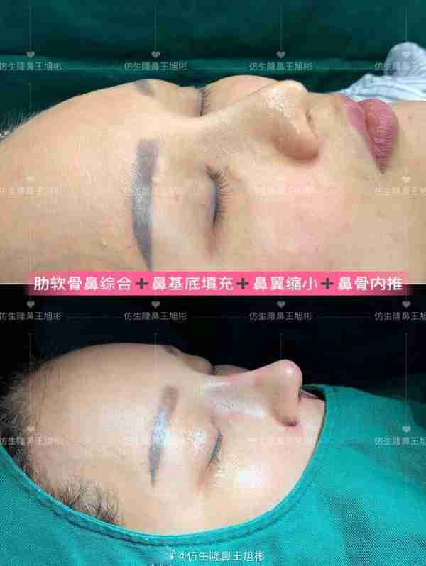 初鼻当心:硅胶假体隆鼻后,什么原因会造成包膜挛缩?可防可治吗