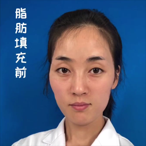 自体脂肪填充全脸后为什么会面部僵硬?填充失败了吗?听听医生说